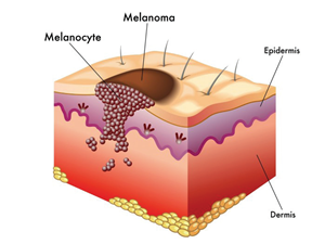 The neo - natural formation, which can be removed with the help of Skincell Pro