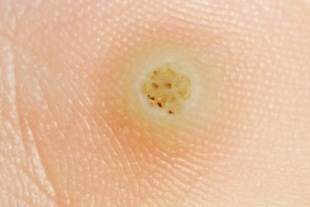 What does a wart look like
