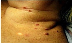 Picture of multiple papillomas in women