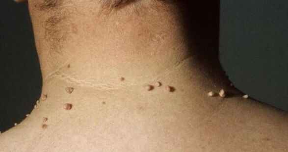 Small papilloma on the neck