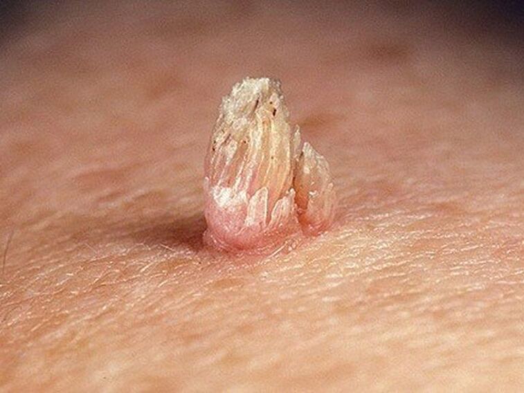 Genital papilloma on the body