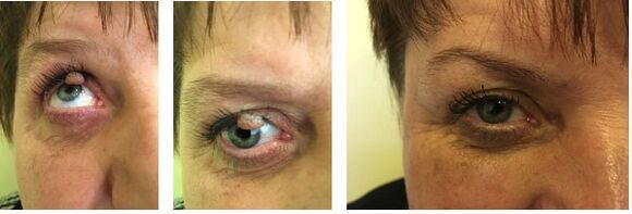 Removal of papilloma on the eyelids