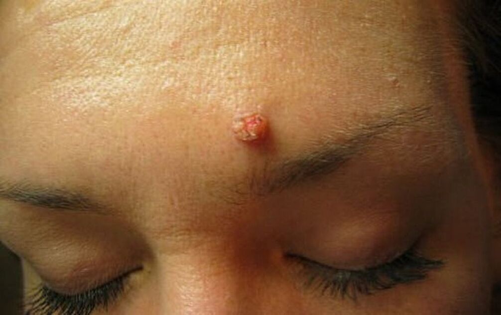 Warts on the forehead