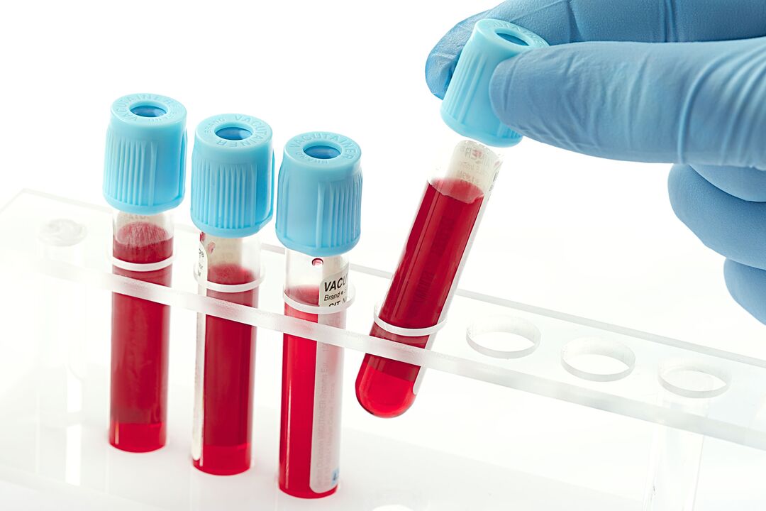 Blood tests to diagnose human papillomavirus