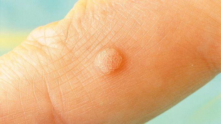 Warts on human skin