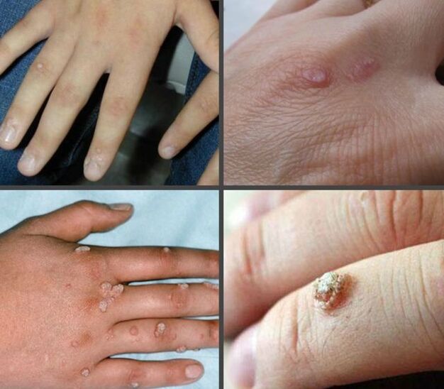 Appearance and location of warts on hands