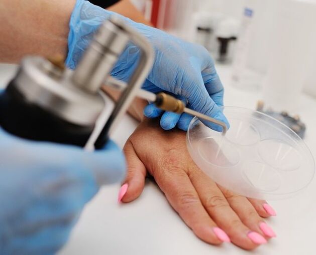 Cryodestruction-a method to remove warts on hands by freezing with liquid nitrogen