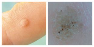 Common warts under examination and dermoscopy