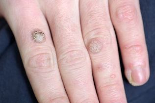 Warts on hands