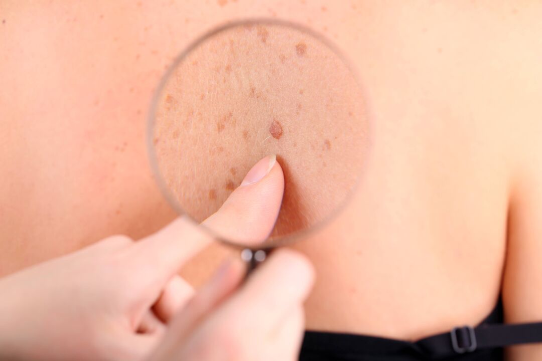 Skin papillomas that can be removed at home